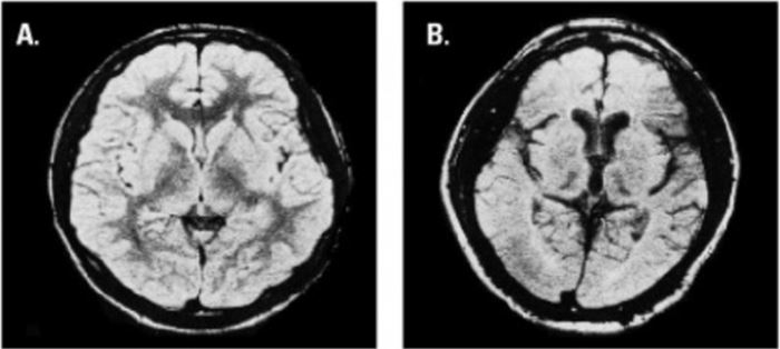 정상인의 뇌(왼쪽)와 톨루엔 중독에 의해 손상된 뇌(오른쪽), 출처: NIDA